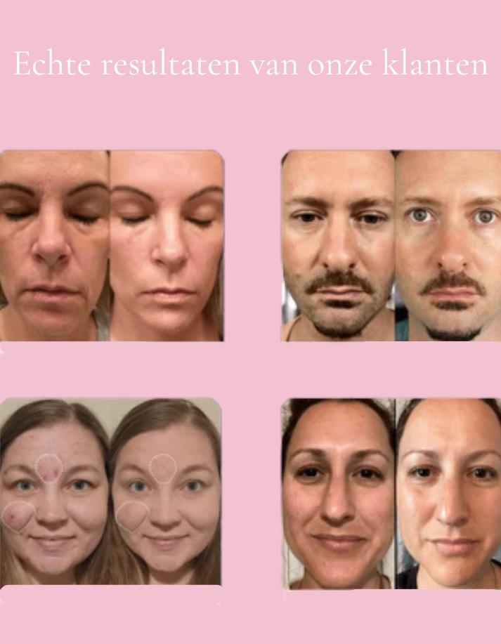 LumiLift™ | LED Eye Rejuvenation Wand